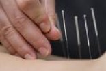 About Acupuncture  #01